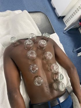Acupuncture